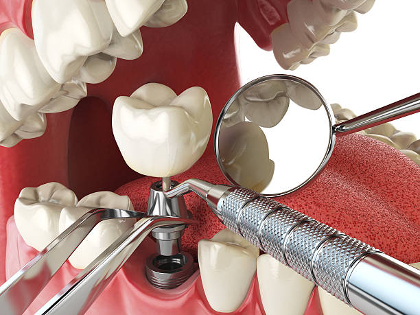 Best Emergency Dental Extractions in Bensenvle, IL